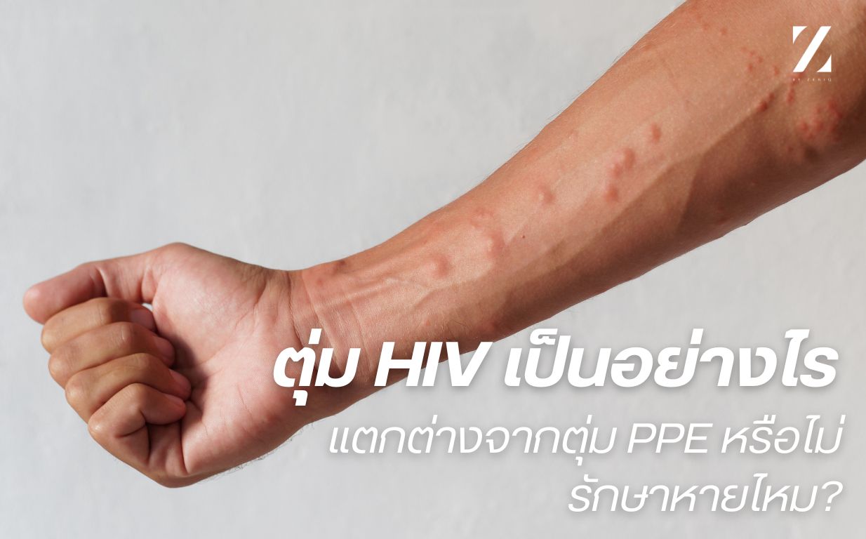 ตุ่ม Hiv